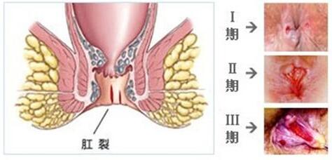 预防肛裂复发