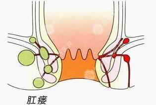 肛瘘危害 肛瘘危害有哪些